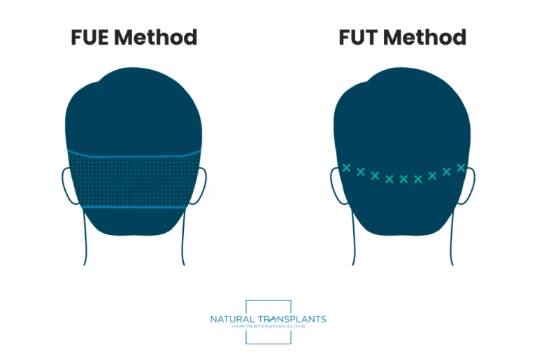 FUE vs FUT Hair Transplants