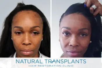 Female Hair Transplant